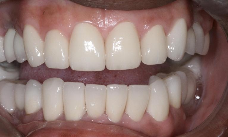 Smile-Rehabilitation-After-Image