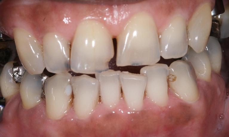 Smile-Rehabilitation-Before-Image