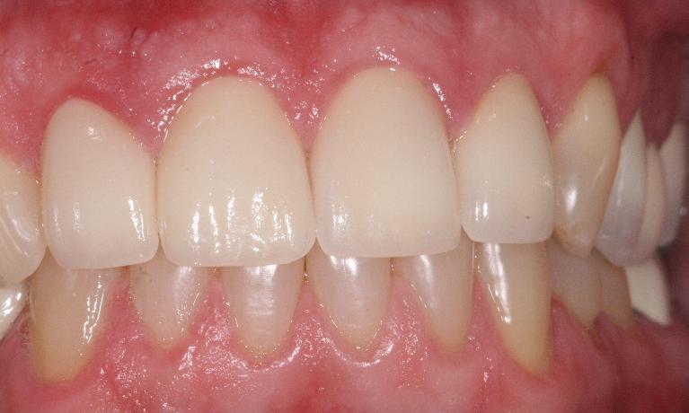 Crowns-and-Veneers-After-Image