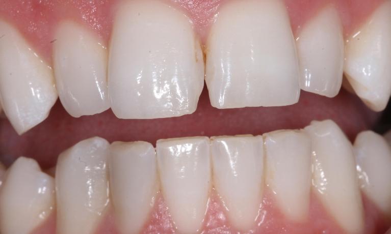 Cosmetic-Bonding-Before-Image