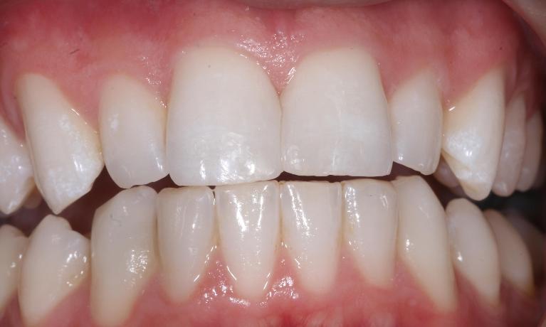 Cosmetic-Bonding-After-Image