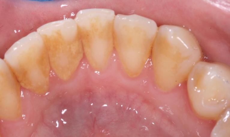 Hygiene-Periodontal-Before-Image