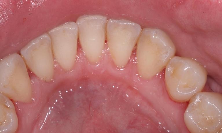 Hygiene-Periodontal-After-Image