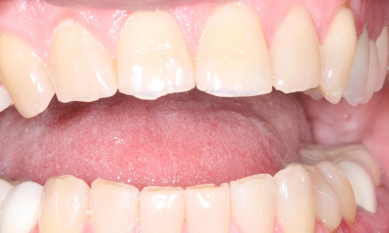 Crowns-and-Veneers-Before-Image